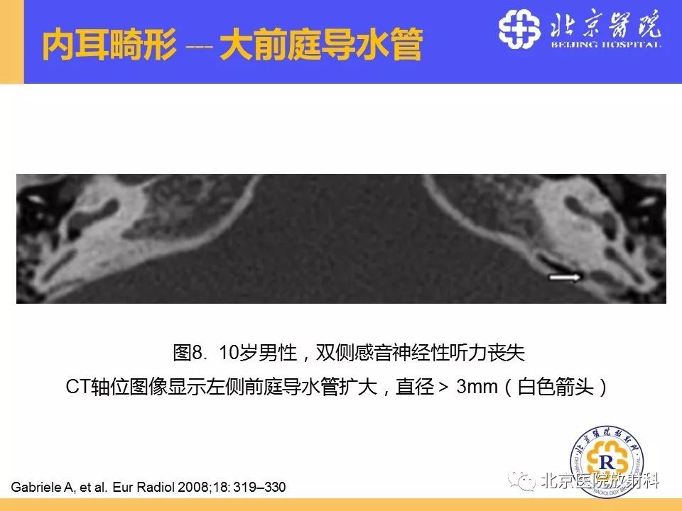 影像PPT - 【PPT】常见内耳畸形及后天获得性病变的影像表现-24