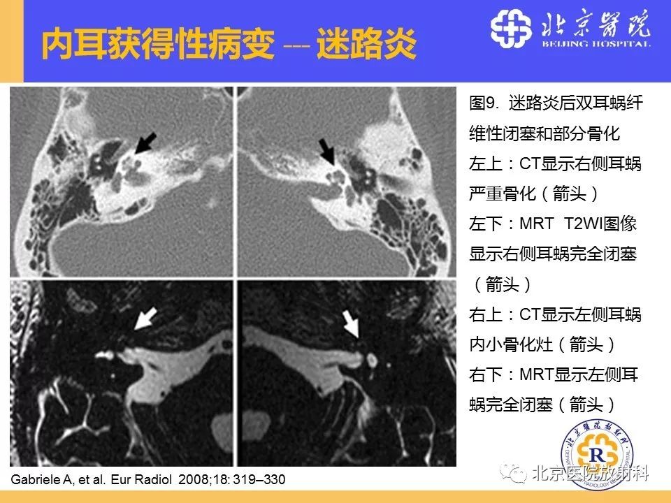 影像PPT - 【PPT】常见内耳畸形及后天获得性病变的影像表现-28