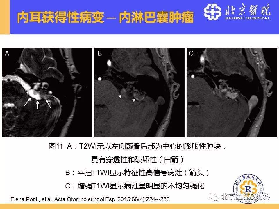 影像PPT - 【PPT】常见内耳畸形及后天获得性病变的影像表现-31