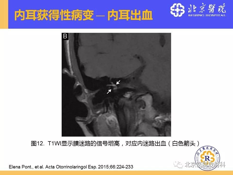 影像PPT - 【PPT】常见内耳畸形及后天获得性病变的影像表现-33