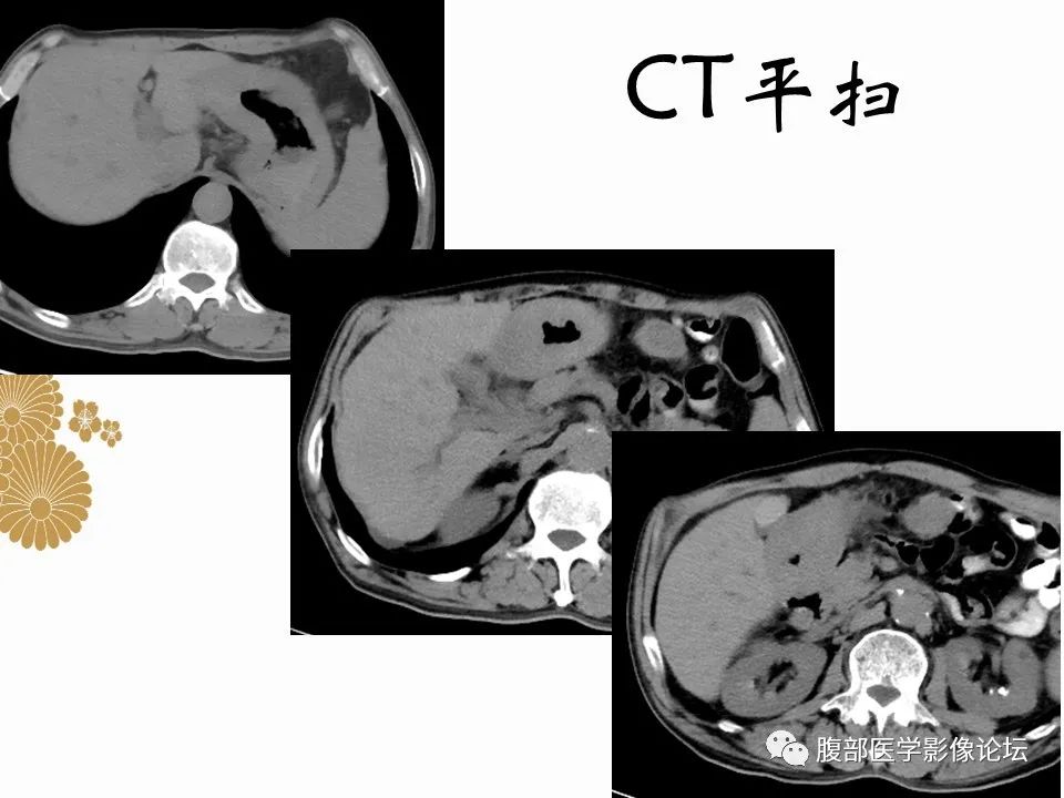 影像PPT - 【病例】胃印戒细胞癌1例CT及MR-4