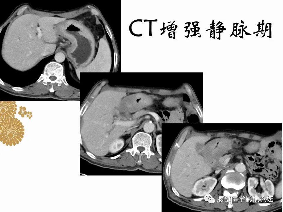 影像PPT - 【病例】胃印戒细胞癌1例CT及MR-6