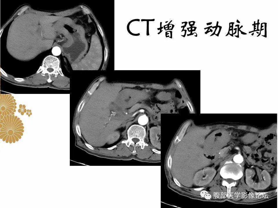 影像PPT - 【病例】胃印戒细胞癌1例CT及MR-5