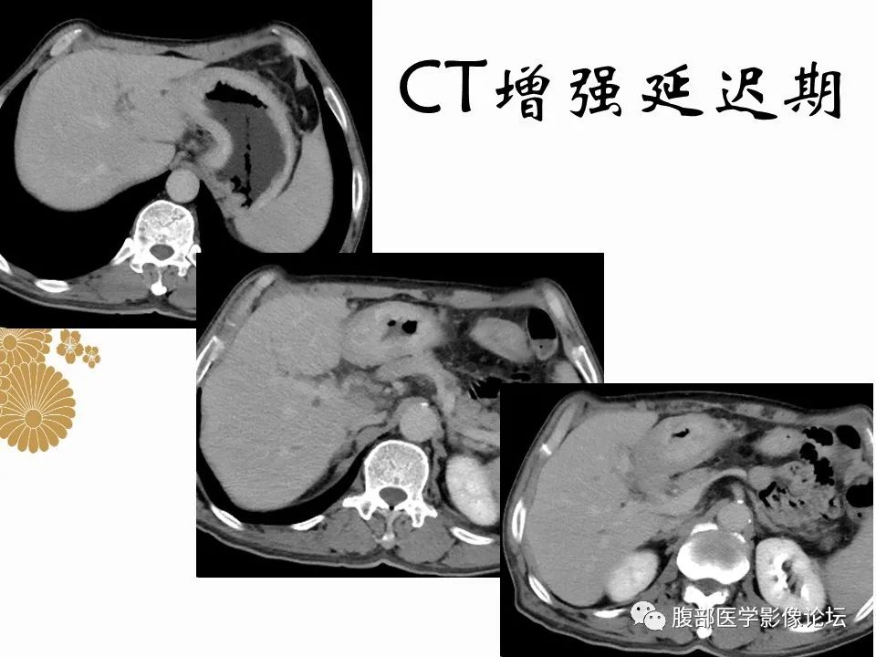 影像PPT - 【病例】胃印戒细胞癌1例CT及MR-7