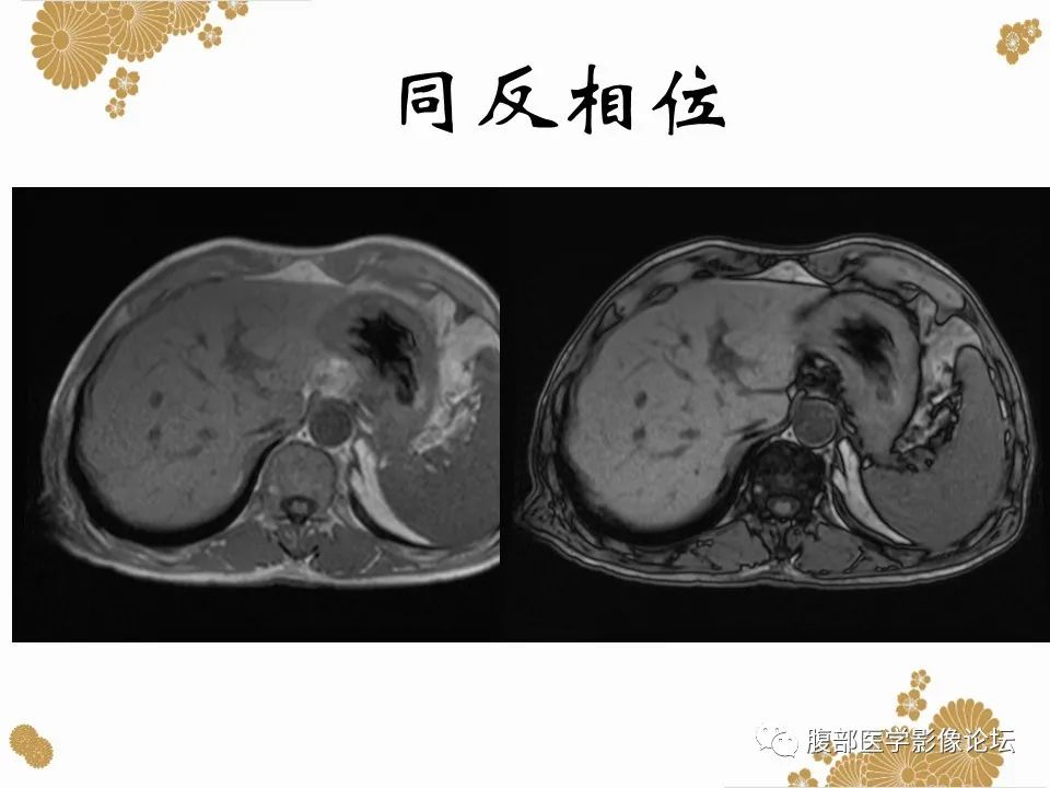 影像PPT - 【病例】胃印戒细胞癌1例CT及MR-8