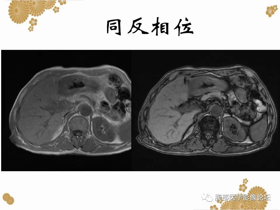 影像PPT - 【病例】胃印戒细胞癌1例CT及MR-9