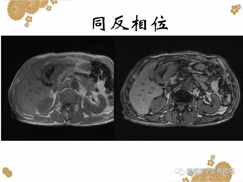 影像PPT - 【病例】胃印戒细胞癌1例CT及MR-10