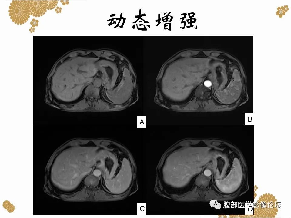 影像PPT - 【病例】胃印戒细胞癌1例CT及MR-15