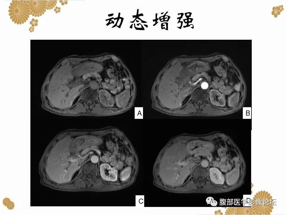 影像PPT - 【病例】胃印戒细胞癌1例CT及MR-16