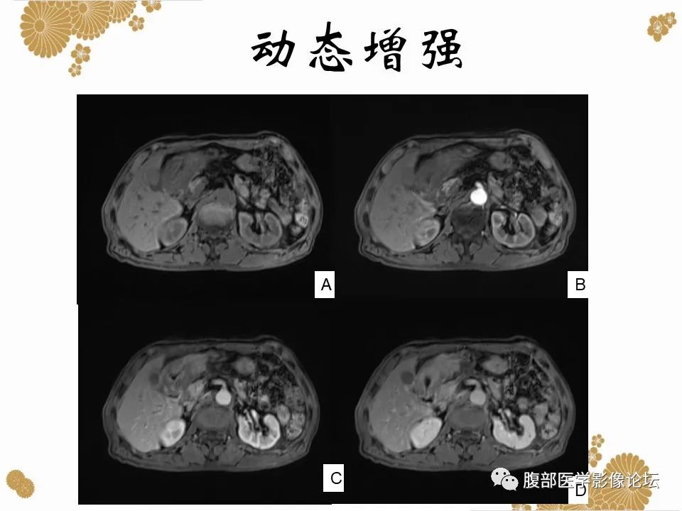 影像PPT - 【病例】胃印戒细胞癌1例CT及MR-17