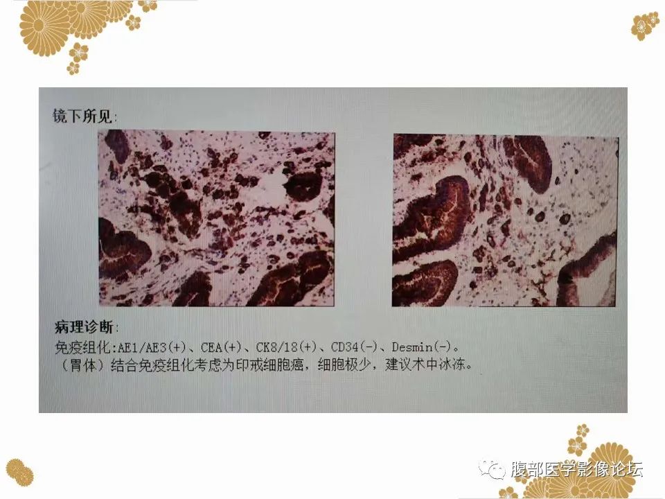 影像PPT - 【病例】胃印戒细胞癌1例CT及MR-20