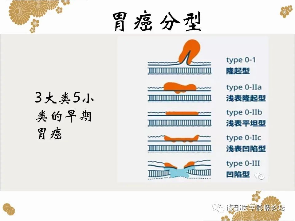 影像PPT - 【病例】胃印戒细胞癌1例CT及MR-23