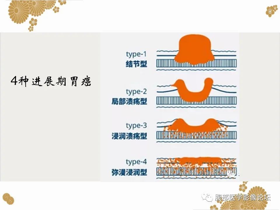 影像PPT - 【病例】胃印戒细胞癌1例CT及MR-24
