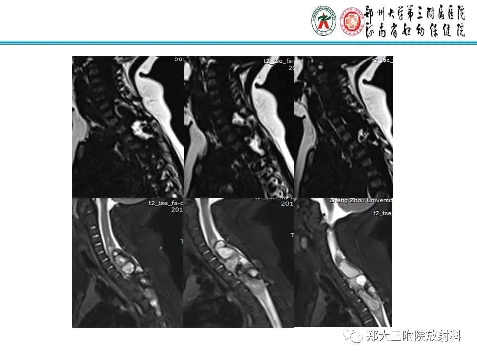 影像PPT - 【PPT】皮样囊肿与表皮样囊肿-3