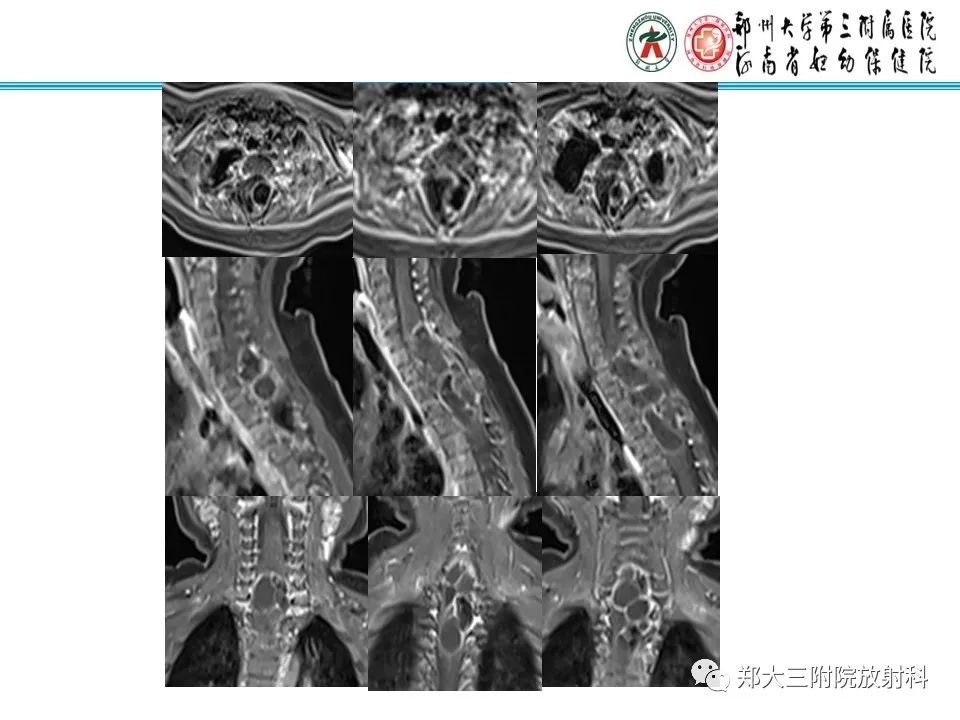 影像PPT - 【PPT】皮样囊肿与表皮样囊肿-5