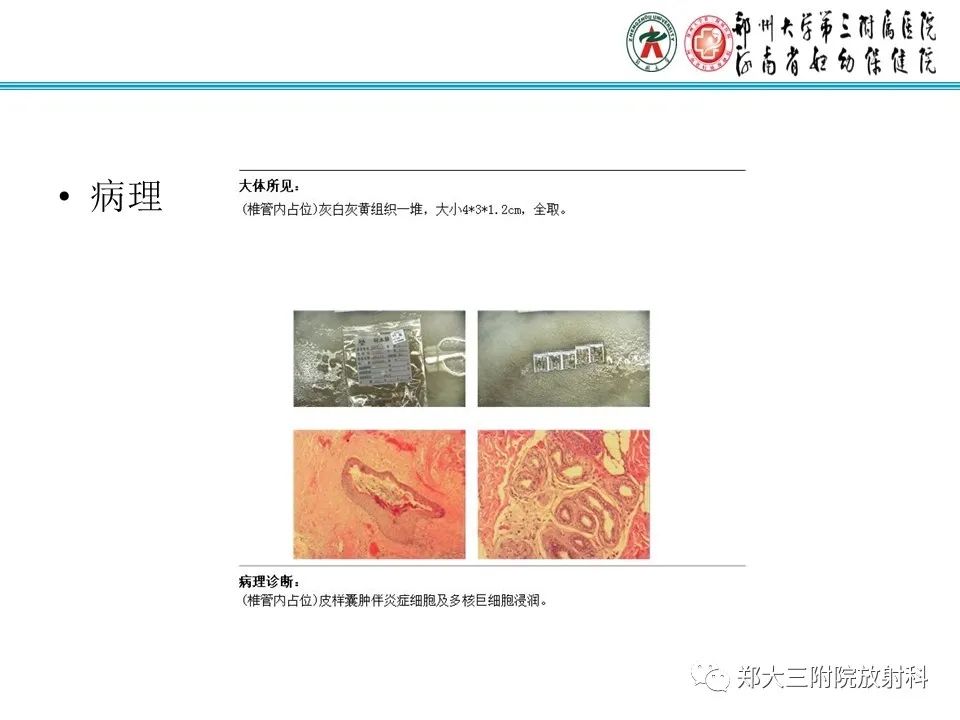 影像PPT - 【PPT】皮样囊肿与表皮样囊肿-6