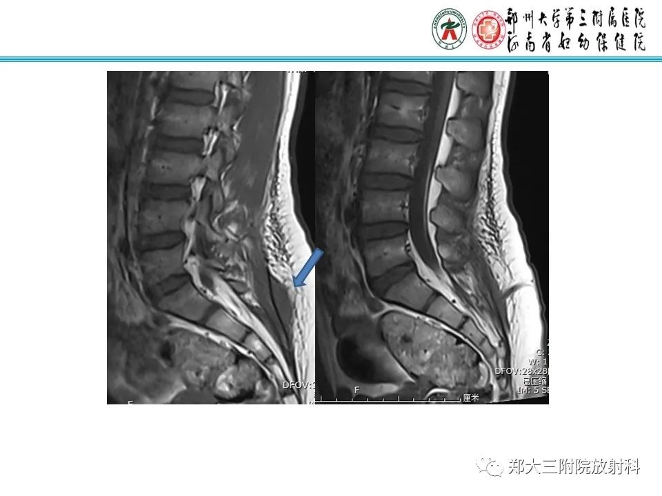 影像PPT - 【PPT】皮样囊肿与表皮样囊肿-8
