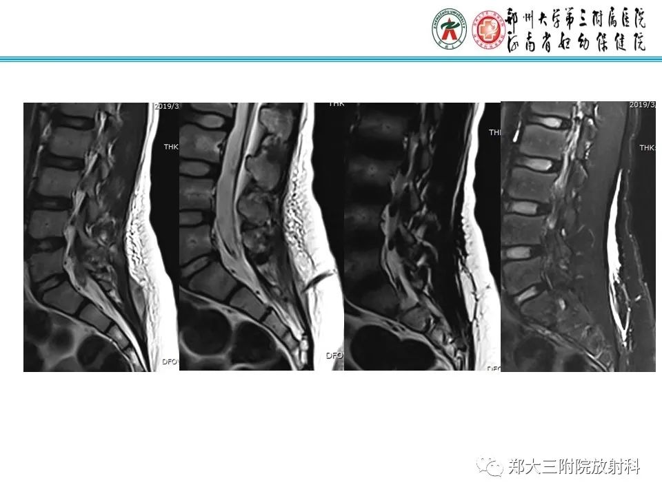 影像PPT - 【PPT】皮样囊肿与表皮样囊肿-9