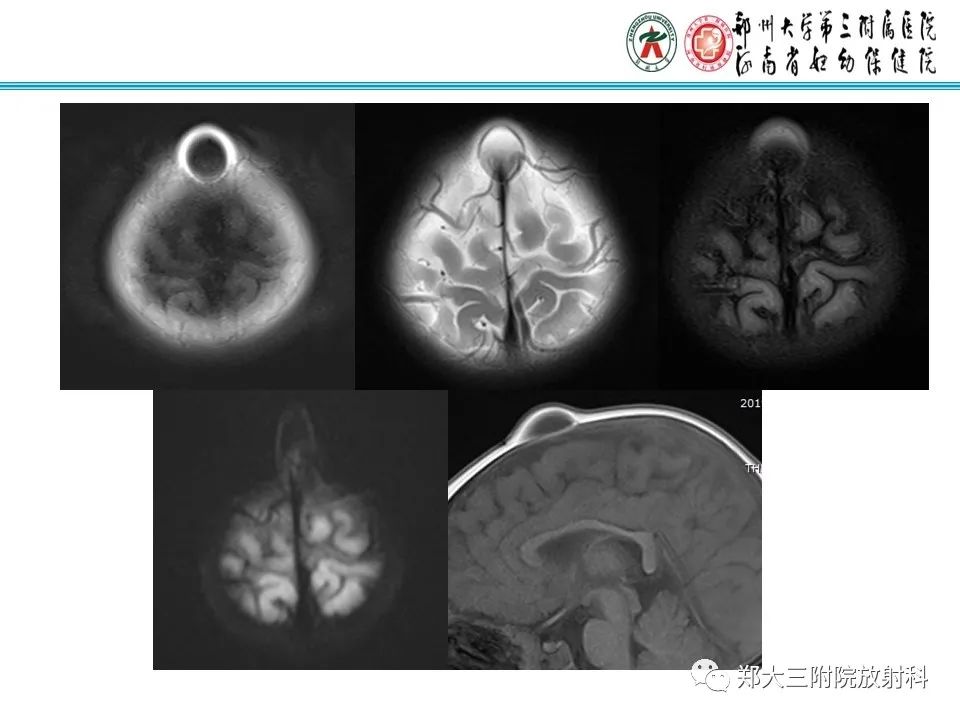 影像PPT - 【PPT】皮样囊肿与表皮样囊肿-30