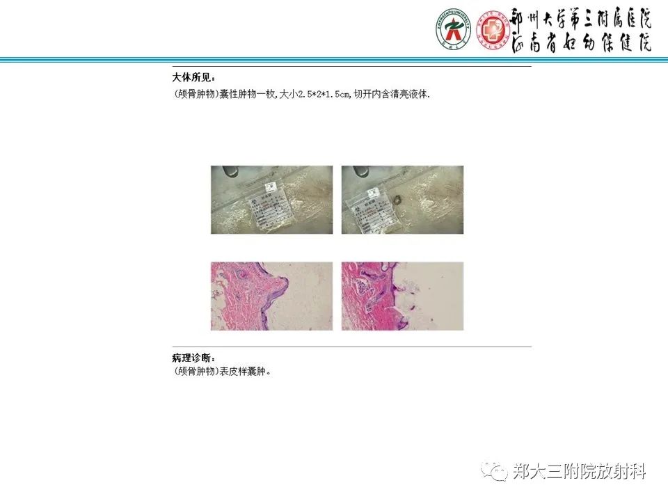 影像PPT - 【PPT】皮样囊肿与表皮样囊肿-31