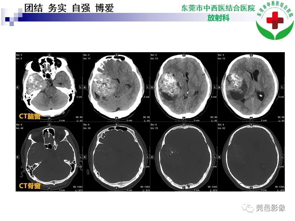 影像PPT - 【PPT】颅内海绵状血管瘤的影像诊断-4