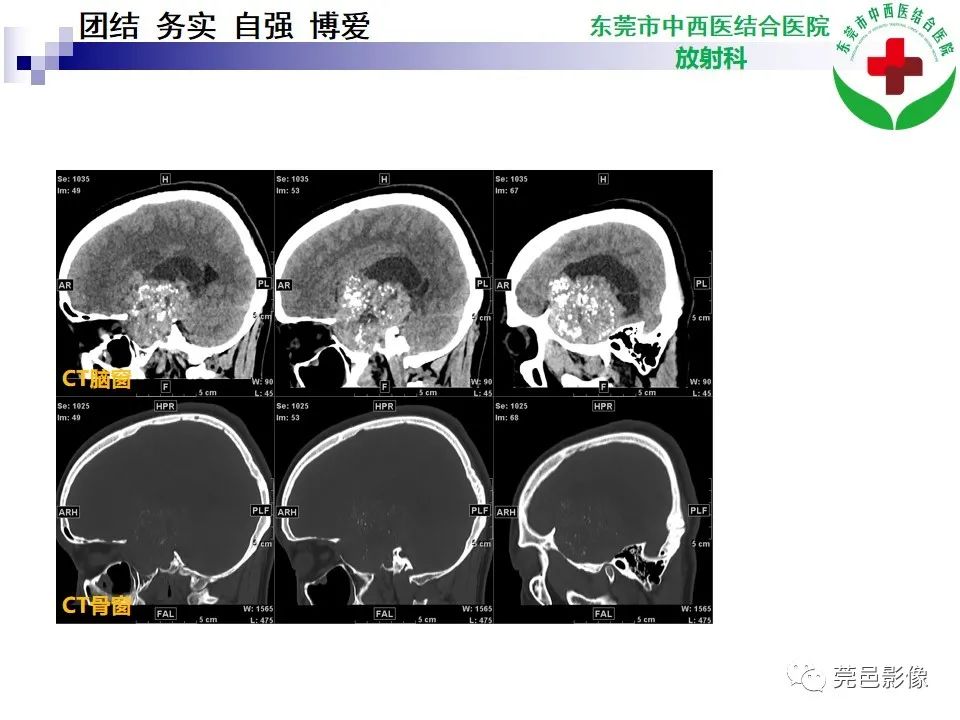 影像PPT - 【PPT】颅内海绵状血管瘤的影像诊断-6