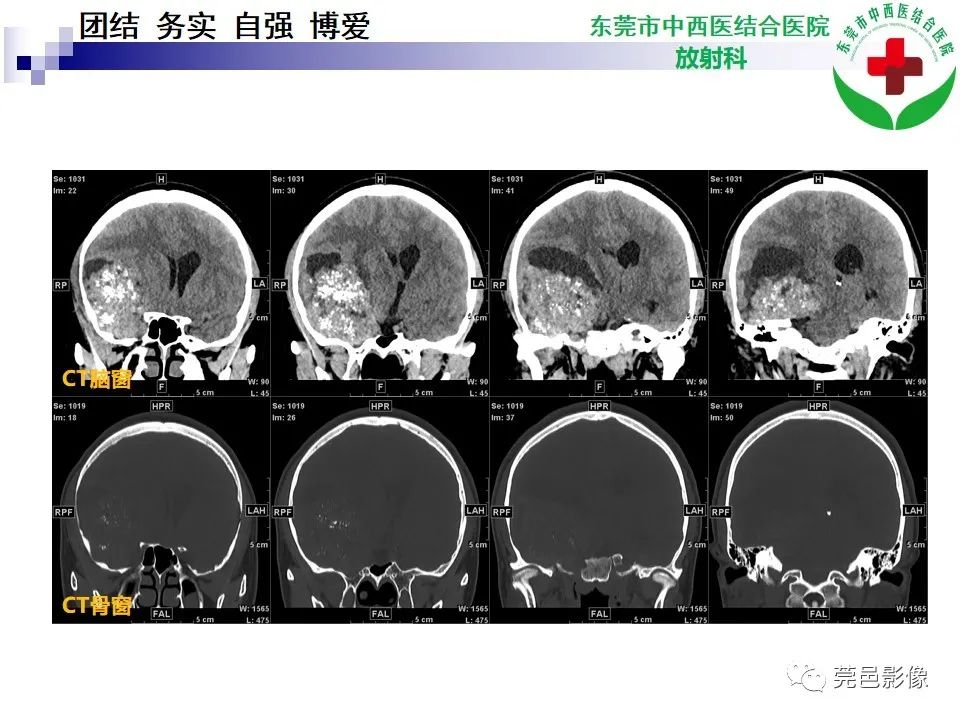 影像PPT - 【PPT】颅内海绵状血管瘤的影像诊断-5