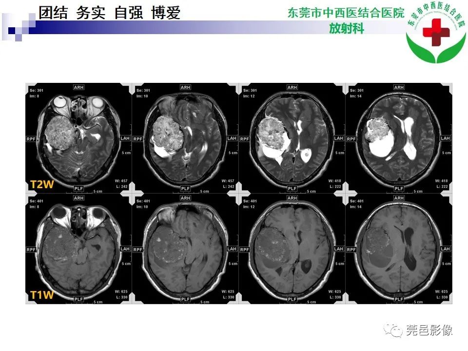 影像PPT - 【PPT】颅内海绵状血管瘤的影像诊断-7