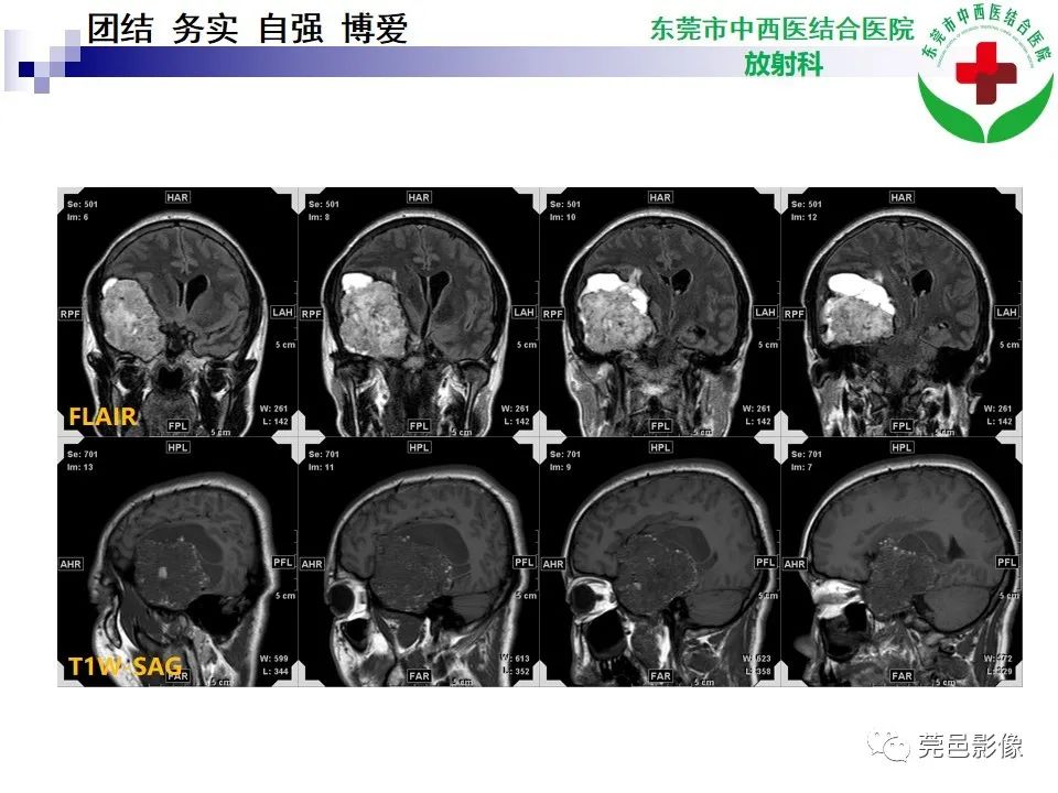 影像PPT - 【PPT】颅内海绵状血管瘤的影像诊断-8