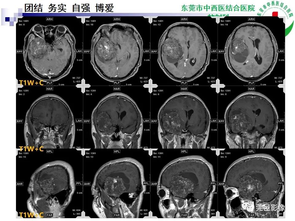 影像PPT - 【PPT】颅内海绵状血管瘤的影像诊断-9