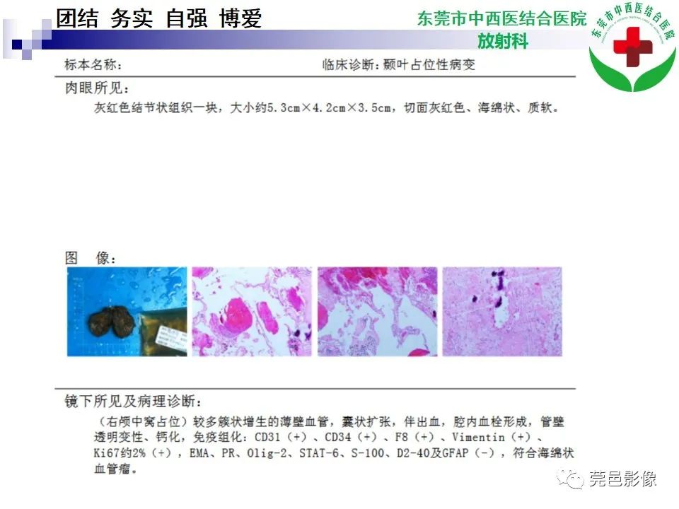 影像PPT - 【PPT】颅内海绵状血管瘤的影像诊断-13