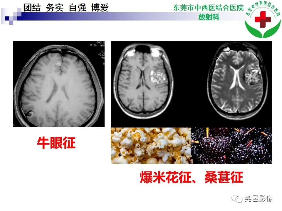 影像PPT - 【PPT】颅内海绵状血管瘤的影像诊断-20