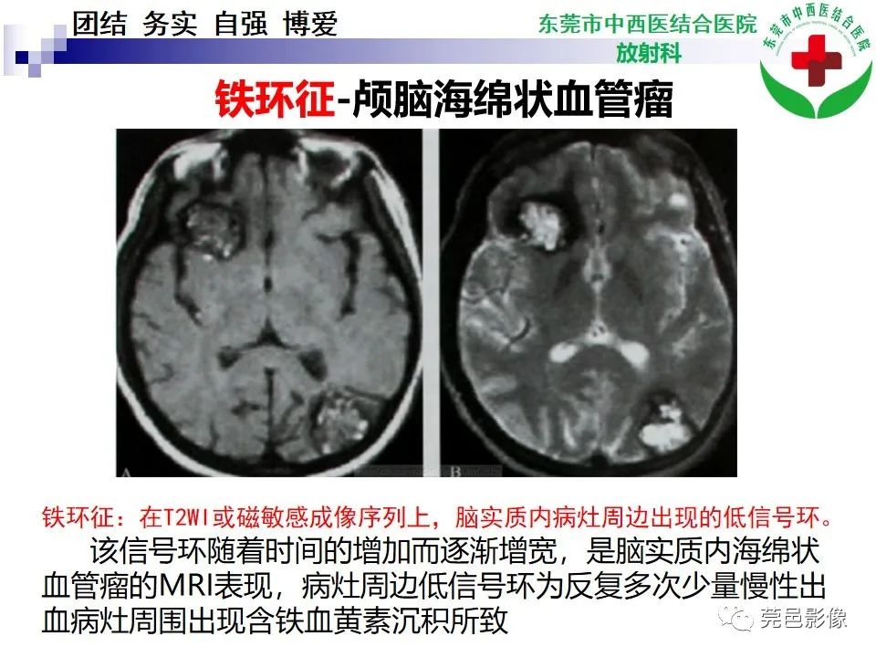 影像PPT - 【PPT】颅内海绵状血管瘤的影像诊断-21