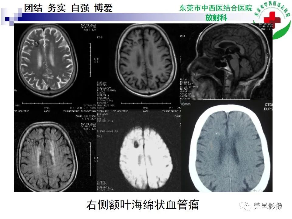 影像PPT - 【PPT】颅内海绵状血管瘤的影像诊断-22