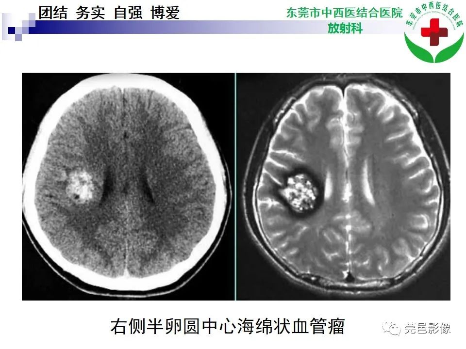 影像PPT - 【PPT】颅内海绵状血管瘤的影像诊断-23