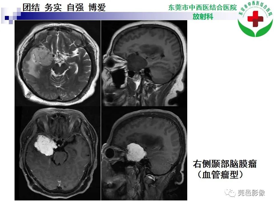 影像PPT - 【PPT】颅内海绵状血管瘤的影像诊断-26