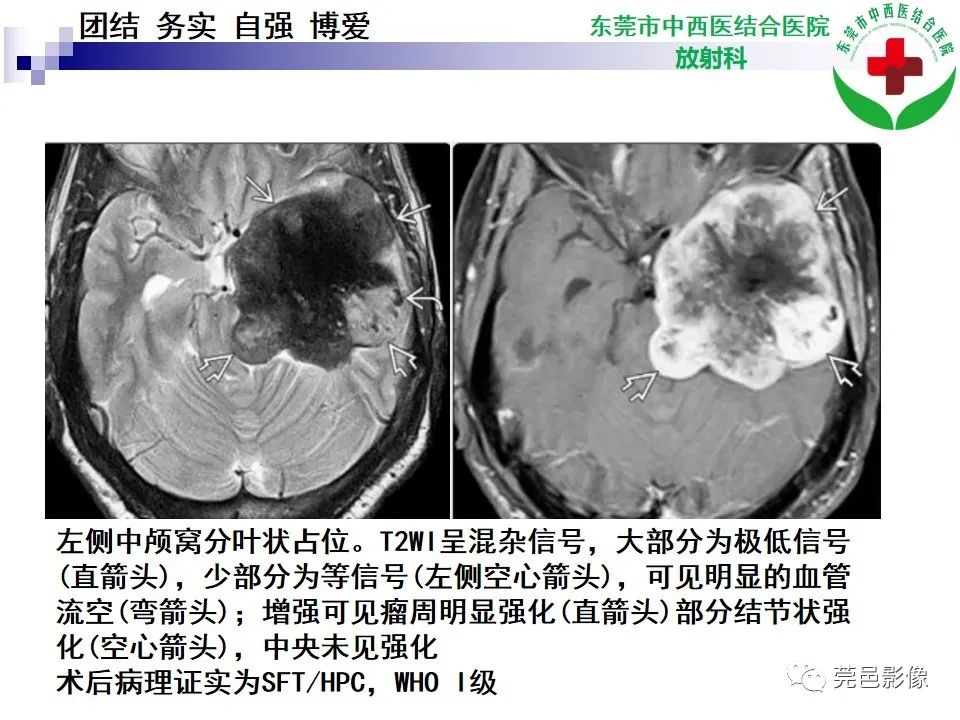 影像PPT - 【PPT】颅内海绵状血管瘤的影像诊断-28