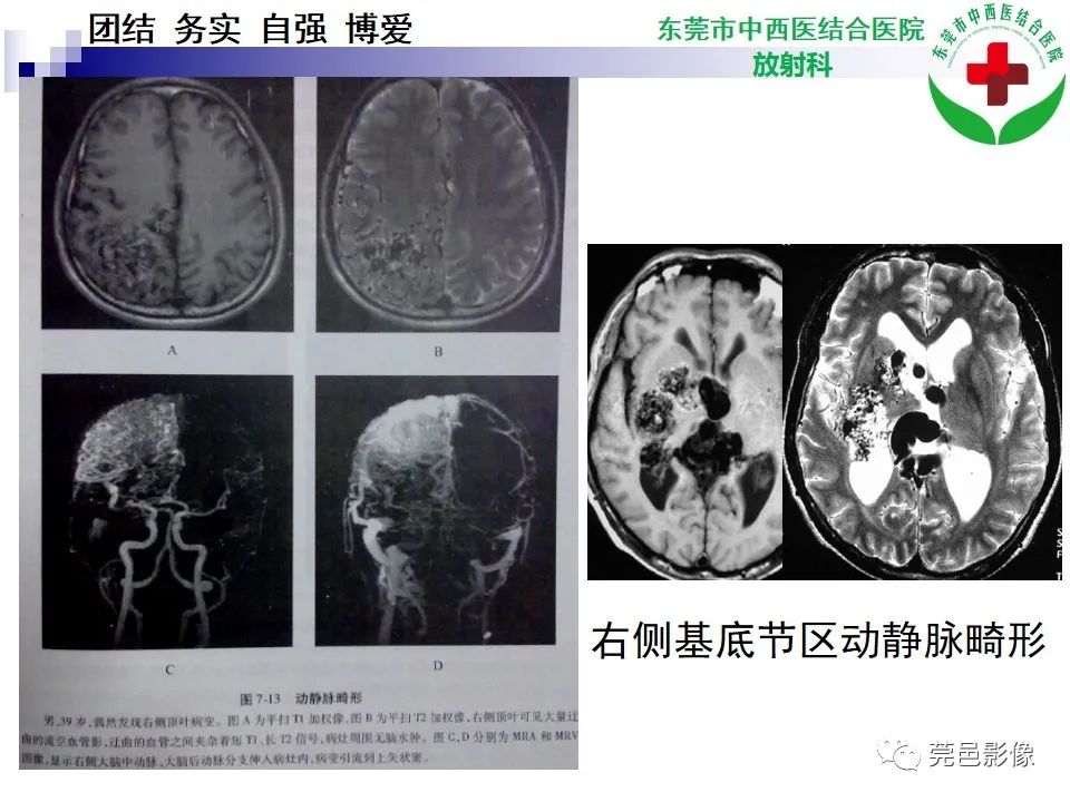 影像PPT - 【PPT】颅内海绵状血管瘤的影像诊断-30