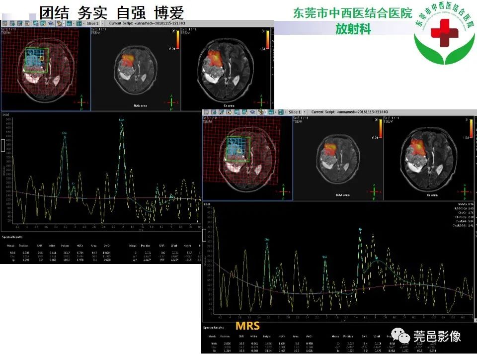 影像PPT - 【PPT】颅内海绵状血管瘤的影像诊断-1