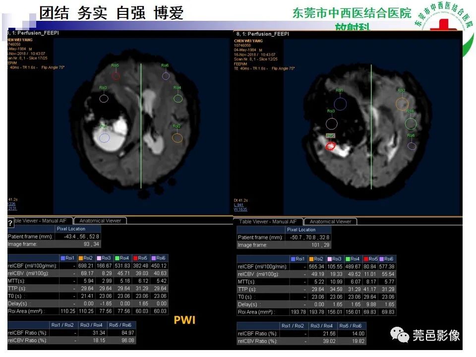 影像PPT - 【PPT】颅内海绵状血管瘤的影像诊断-2