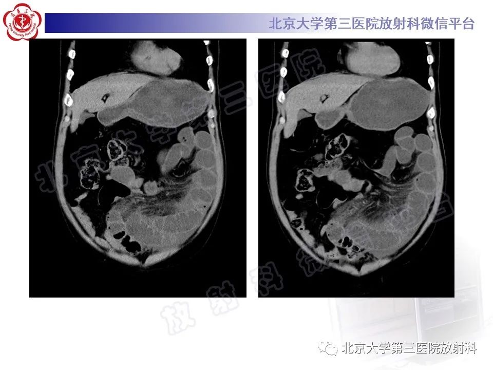 影像PPT - 【PPT】肠梗阻CT诊断注意事项-3