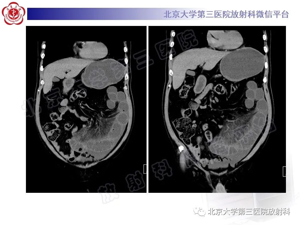 影像PPT - 【PPT】肠梗阻CT诊断注意事项-4