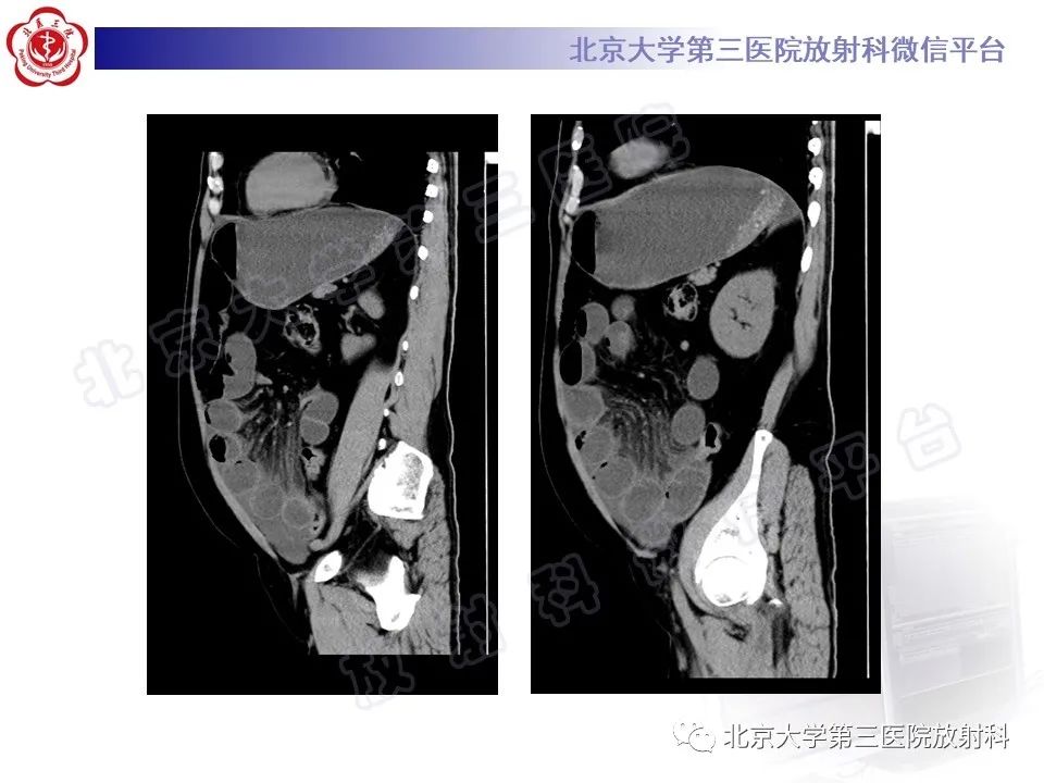 影像PPT - 【PPT】肠梗阻CT诊断注意事项-5
