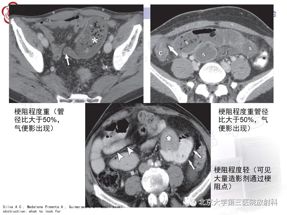 影像PPT - 【PPT】肠梗阻CT诊断注意事项-14