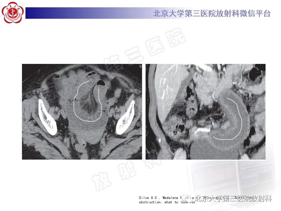 影像PPT - 【PPT】肠梗阻CT诊断注意事项-19