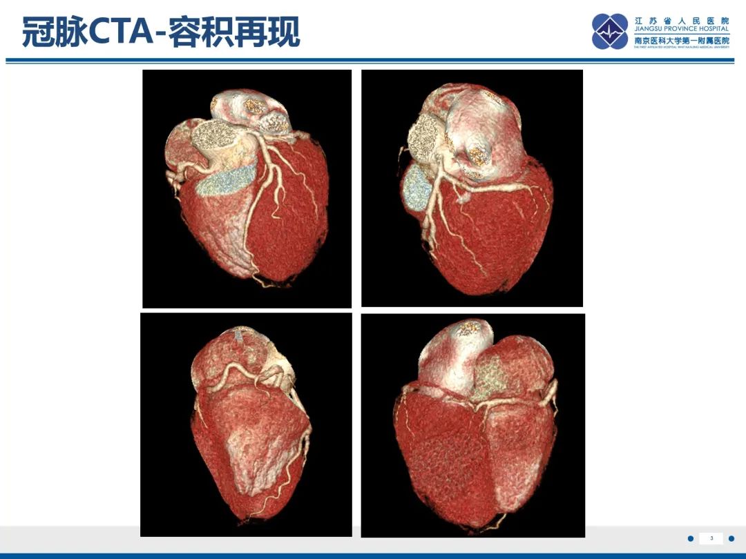 影像PPT - 【PPT】冠脉非阻塞型心肌梗死-4