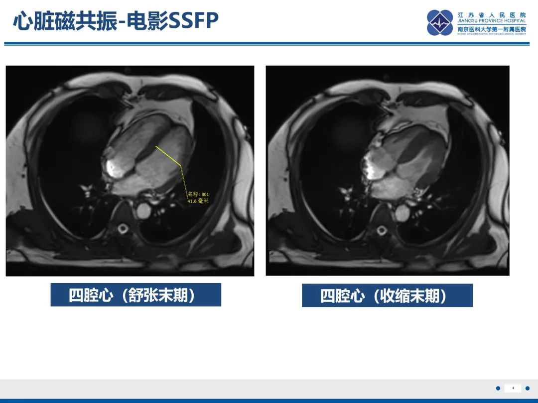 影像PPT - 【PPT】冠脉非阻塞型心肌梗死-5