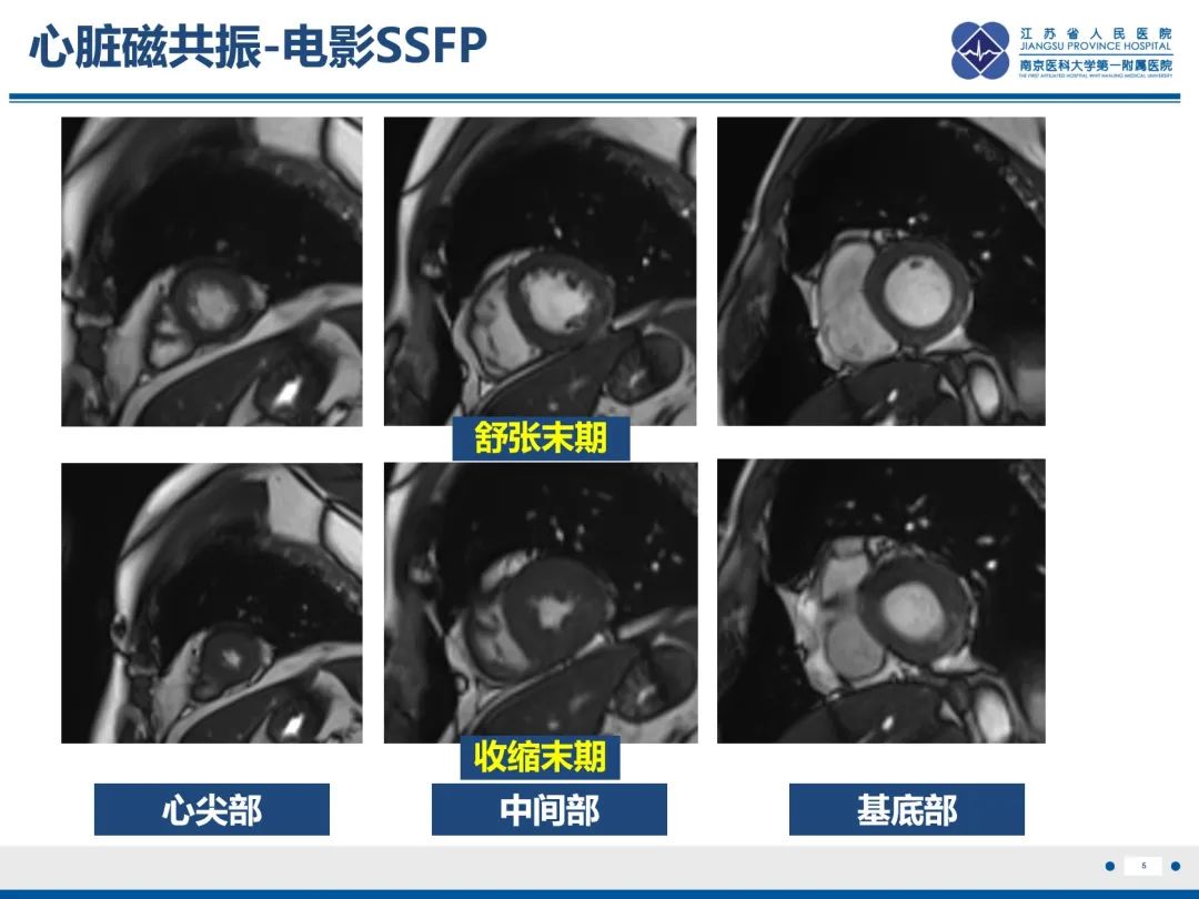 影像PPT - 【PPT】冠脉非阻塞型心肌梗死-6
