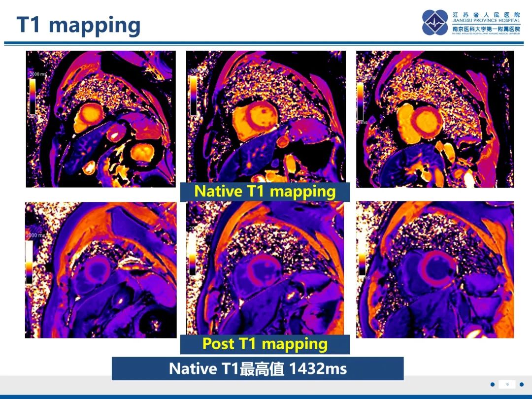 影像PPT - 【PPT】冠脉非阻塞型心肌梗死-7