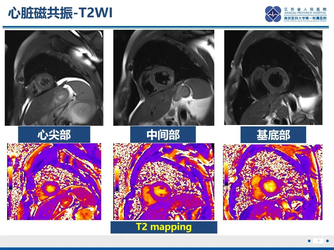影像PPT - 【PPT】冠脉非阻塞型心肌梗死-8